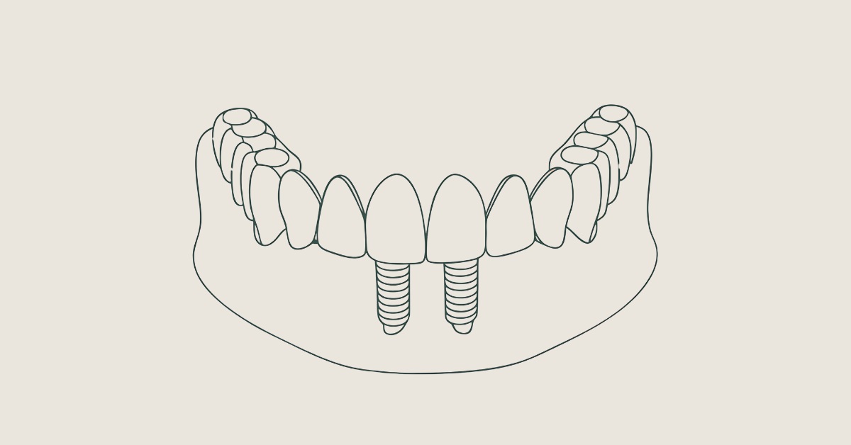 Implantes Dentários: Processo, Cuidados e Custos