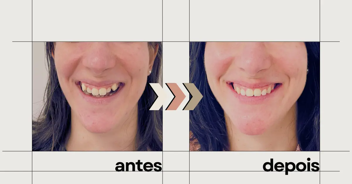 Recuperar a Autoestima Através do Sorriso: Antes e Depois que Mudam Vidas