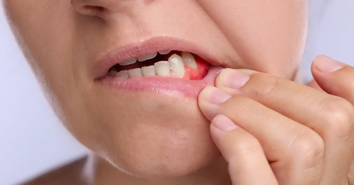 Sangramento das Gengivas: Causas, Tratamentos e Quando Deve Preocupar-se