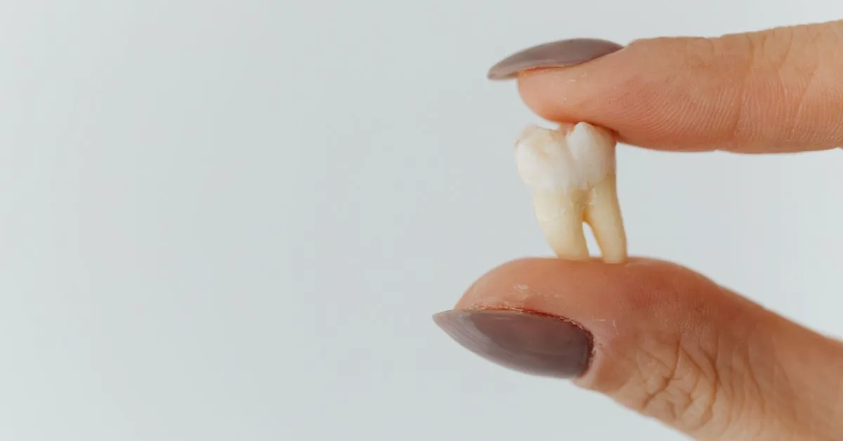 Dentes do Siso: Precisam Sempre de Ser Removidos?