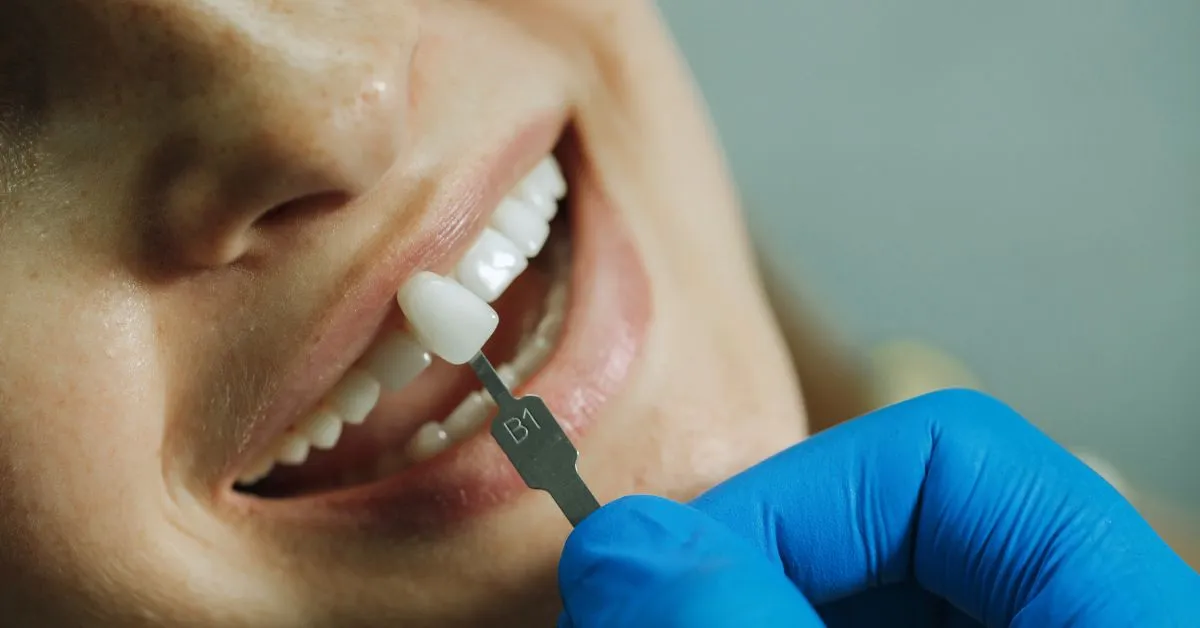 Facetas Dentárias: O Que São, Para Quem Servem e o Que Esperar